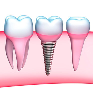 dentistry for you services dental implants background image