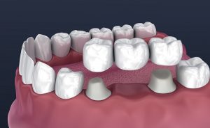 dentistry for you services crown & bridge background image