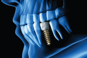 Dental Implants Our Services Dentistry For You Woodbridge Dentist Dental Clinic