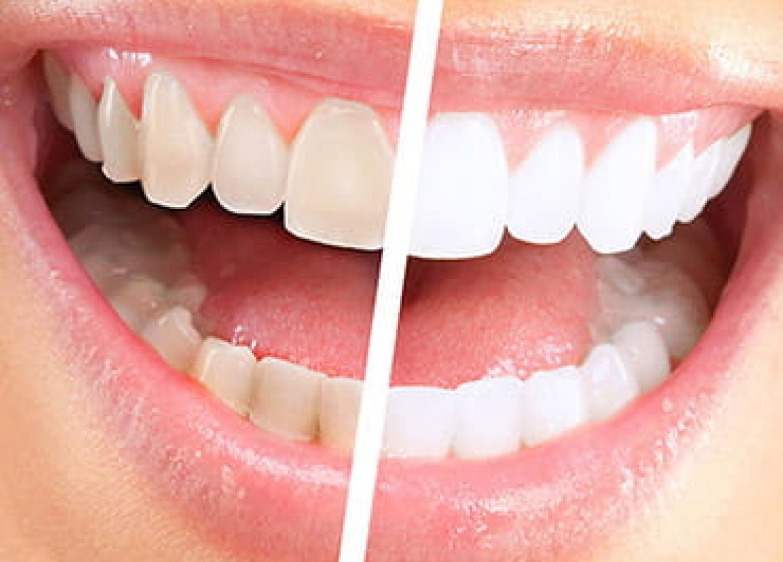 teeth-whitening-sensitivity-dentistry-for-you